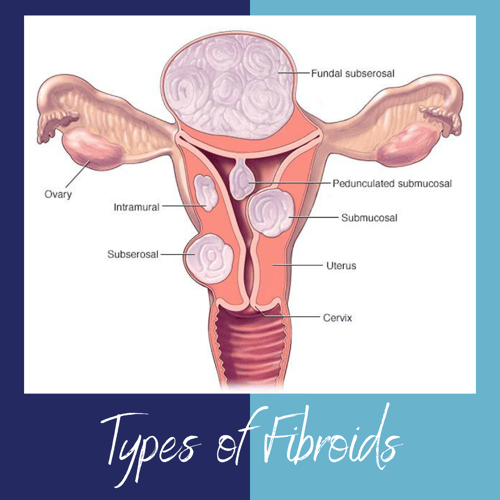 Types of fibroids